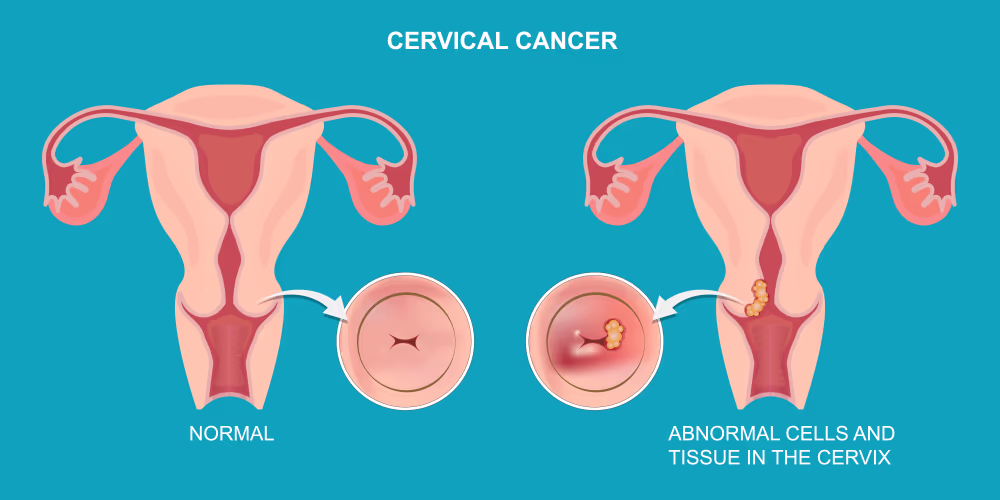 Cervical Cancer Anatomy Cells Vector