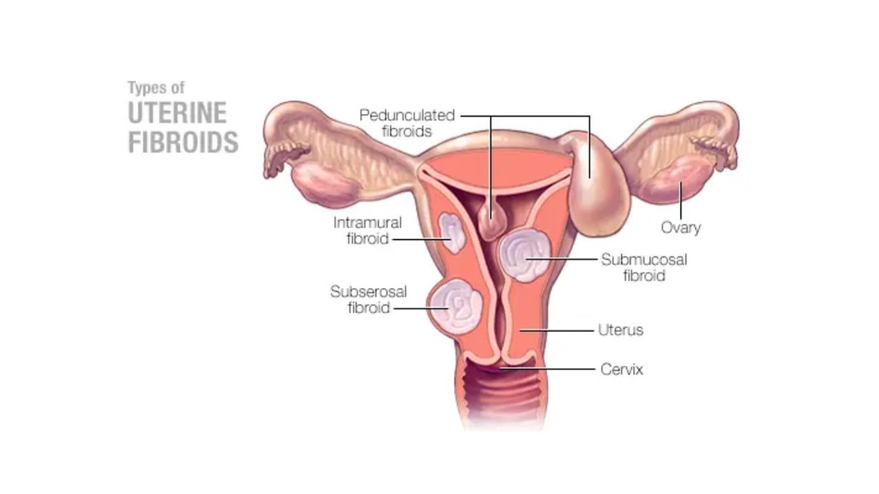 Fibroids Treatment Image