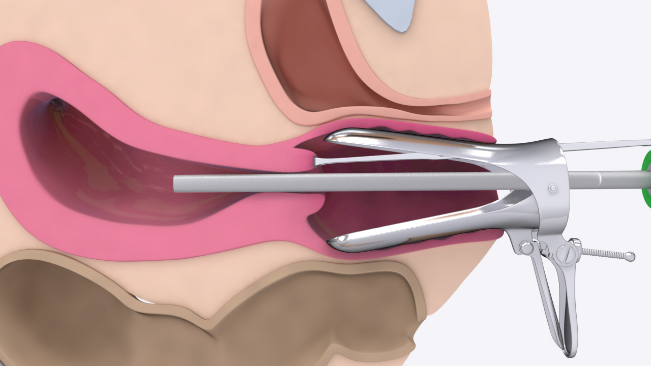 Hysteroscopy Feature Image