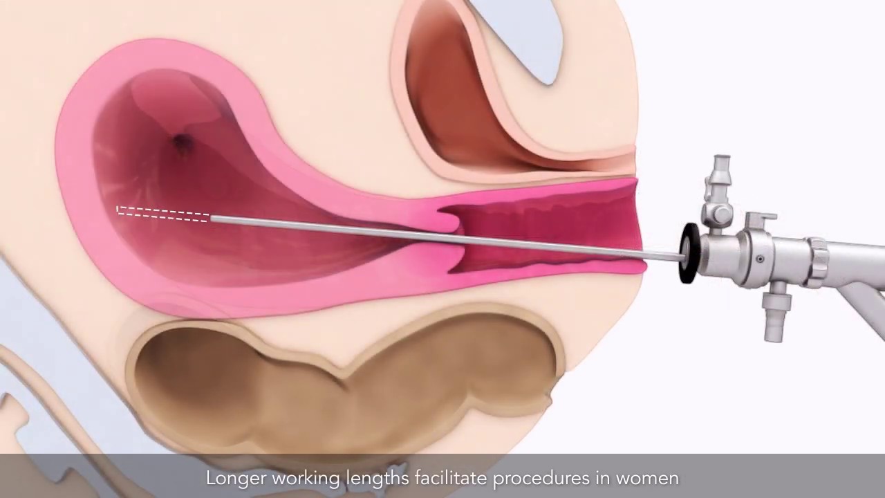 Hysteroscopy Image