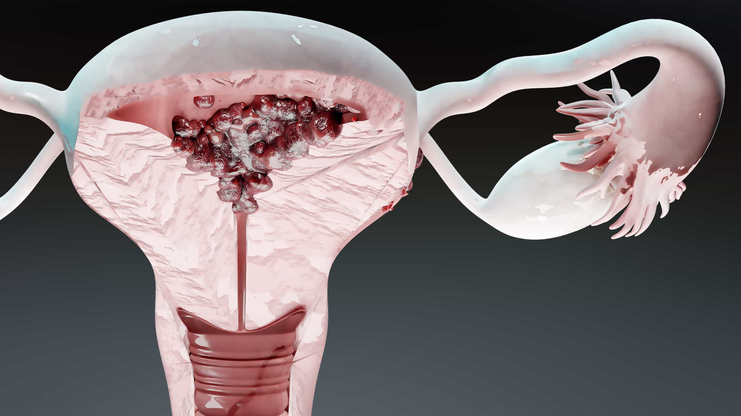 Uterus Cancer