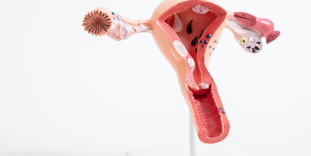 Vulva Cancer Image